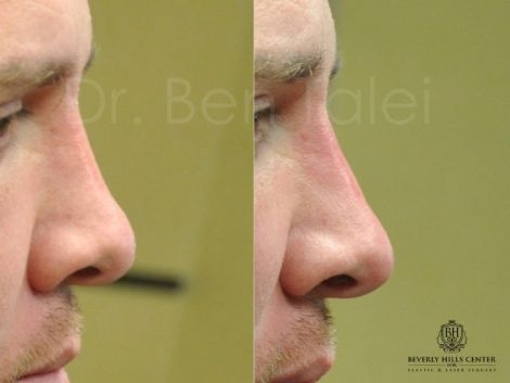 Non Surgical Nosejob