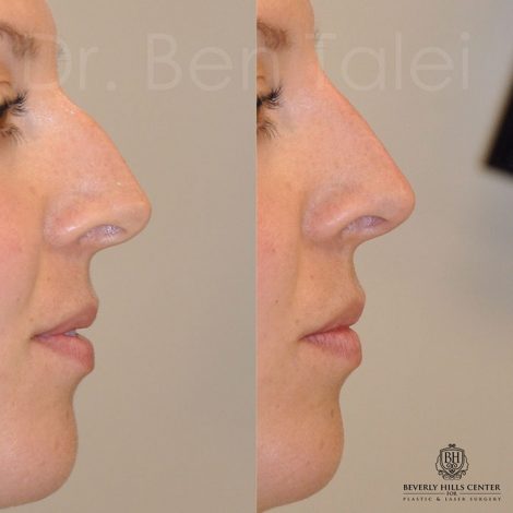 Beverly Hills Center Female Patient Before and After Non-surgical Rhinoplasty Procedure
