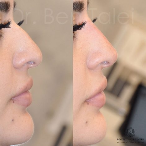 Beverly Hills Center Female Patient Before and After Non-surgical Rhinoplasty Procedure