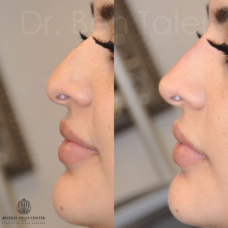 Beverly Hills Center Female Patient Before and After Non-surgical Rhinoplasty Procedure