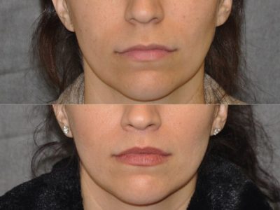 Modified Upper Lip Lift - Front