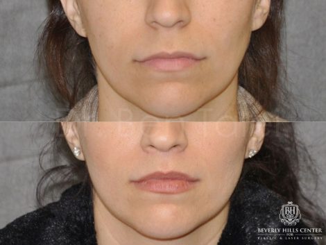 Modified Upper Lip Lift - Front
