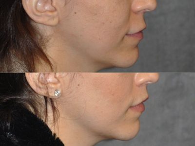 Modified Upper Lip Lift - Right Side