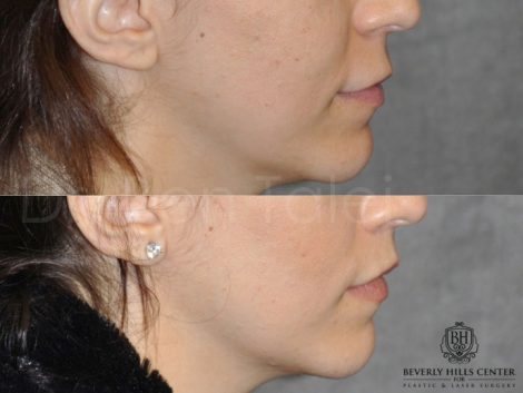 Modified Upper Lip Lift - Right Side