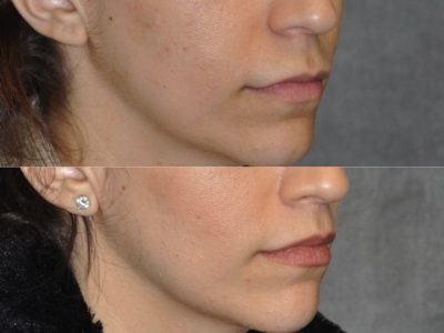 Modified Upper Lip Lift - Right Side