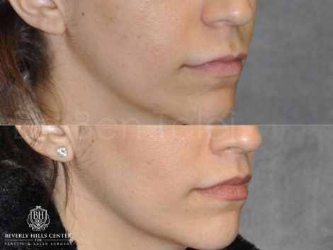 Modified Upper Lip Lift - Right Side