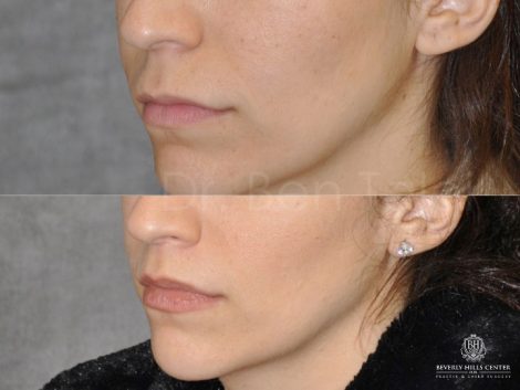 Modified Upper Lip Lift - Left Side