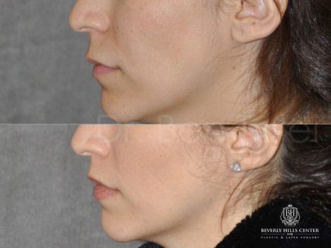 Modified Upper Lip Lift - Left Side