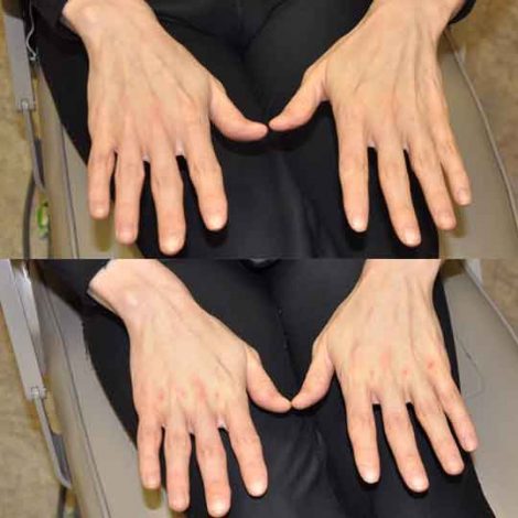 Beverly Hills Center Patient Before and After Hand Rejuvenation Procedure