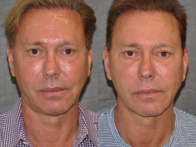 Profound MicroLift with Tri-L Treatment - Front