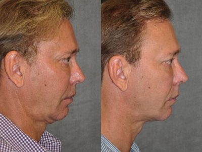 Profound MicroLift with Tri-L Treatment - Right Side