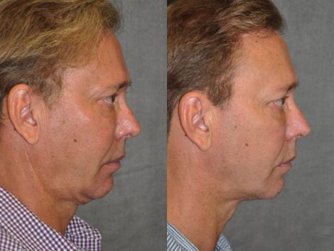 Profound MicroLift with Tri-L Treatment - Right Side