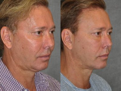 Profound MicroLift with Tri-L Treatment - Right Side