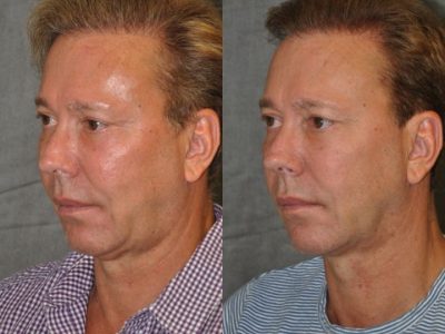 Profound MicroLift with Tri-L Treatment - Left Side