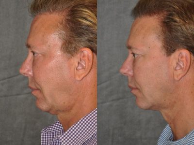 Profound MicroLift with Tri-L Treatment - Left Side
