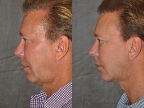 Profound MicroLift with Tri-L Treatment - Left Side