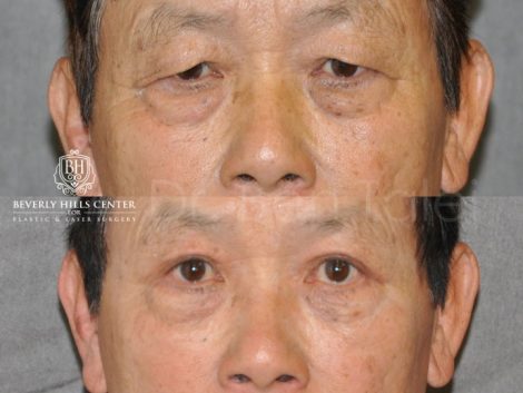 Asian Eyelid Procedure - Front