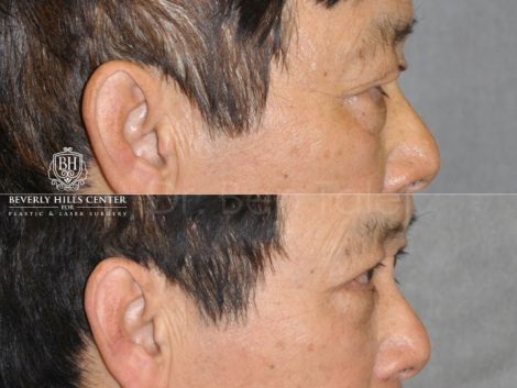 Asian Eyelid Procedure - Right