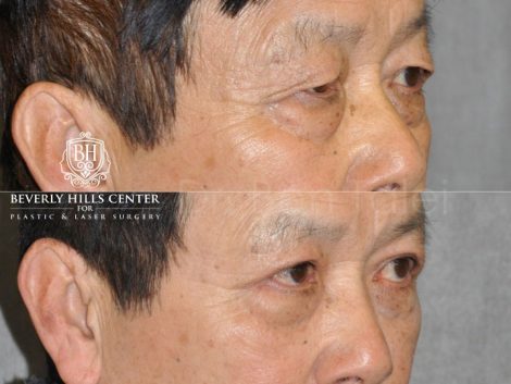 Asian Eyelid Procedure - Right