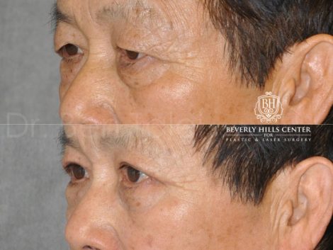 Asian Eyelid Procedure - Left