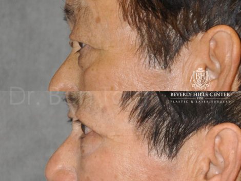 Asian Eyelid Procedure - Left