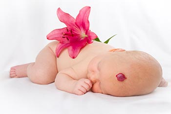 Birthmarks & Pediatric Surgery