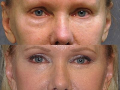 Lower Eyelid Tightening - Front