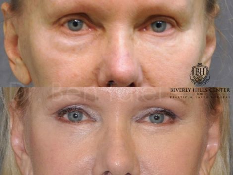 Lower Eyelid Tightening - Front