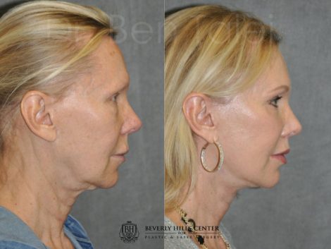 Lip Lift - Right Side