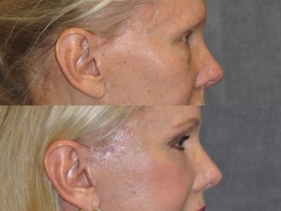 Lower Eyelid Tightening - Right Side