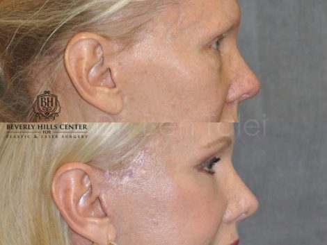 Lower Eyelid Tightening - Right Side