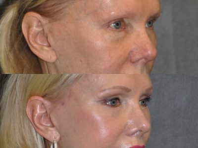 Lower Eyelid Tightening - Right Side