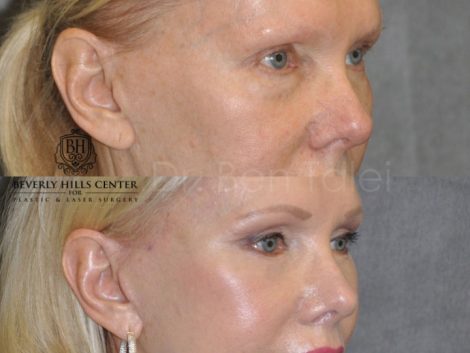 Lower Eyelid Tightening - Right Side
