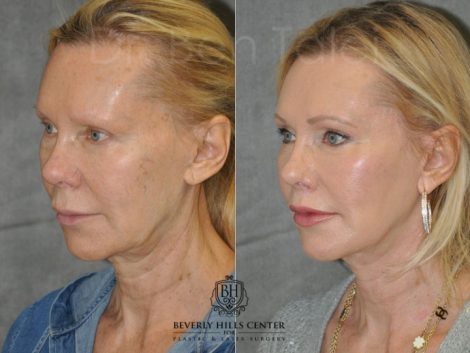 Lip Lift - Left Side