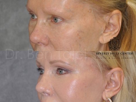 Lower Eyelid Tightening - Left Side