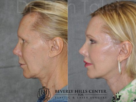 Lip Lift - Left Side