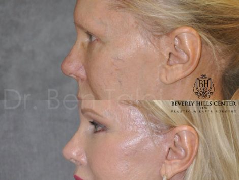 Lower Eyelid Tightening - Left Side