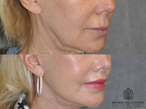 Lip Lift - Close Up