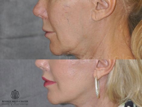 Lip Lift - Close Up
