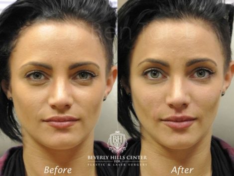 Beverly Hills Center Female Patient Before and After Non-surgical Facial Rejuvenation Procedure