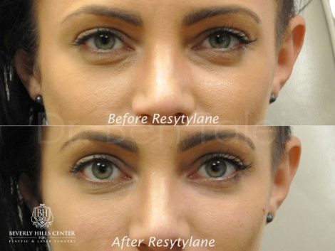 Beverly Hills Center Female Patient Before and After Non-surgical Facial Rejuvenation Procedure