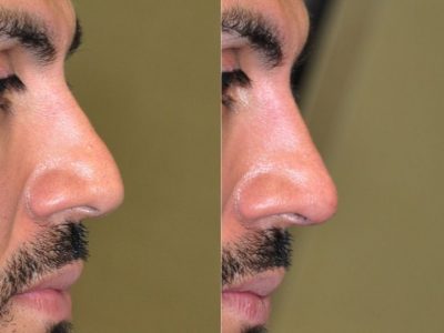 Non Surgical, Liquid Rhinoplasty / Nose Job