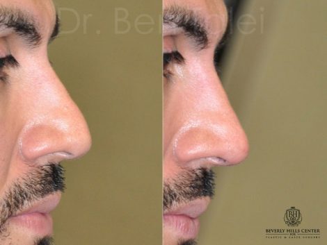 Non Surgical, Liquid Rhinoplasty / Nose Job