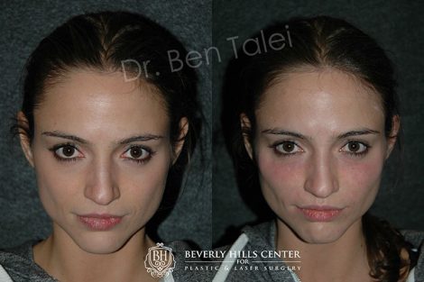 Beverly Hills Center Female Patient Before and After Non-surgical Cheek Procedure