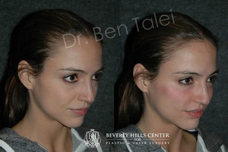 Beverly Hills Center Female Patient Before and After Non-surgical Cheek Procedure