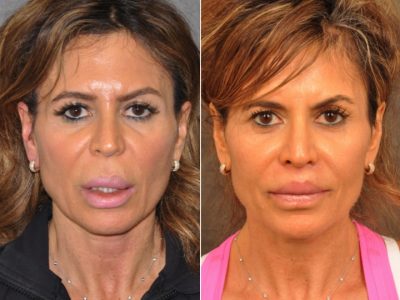 Modified Upper Lip Lift for Silicone Correction – Front