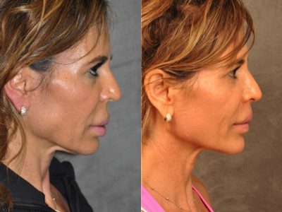 Modified Upper Lip Lift for Silicone Correction – Right Side
