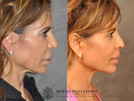 Modified Upper Lip Lift for Silicone Correction - Right Side