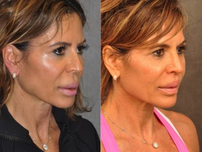 Modified Upper Lip Lift for Silicone Correction – Right Side