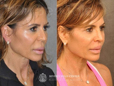 Modified Upper Lip Lift for Silicone Correction - Right Side